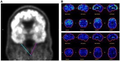 Transient Epileptic Amnesia: A Treatable Cause of Spells Associated With Persistent Cognitive Symptoms